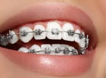 Braces Treatment